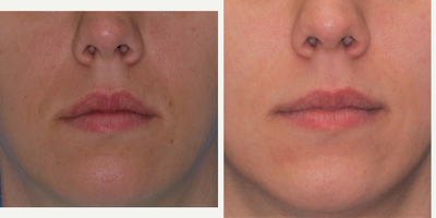 Restylane before and after photo