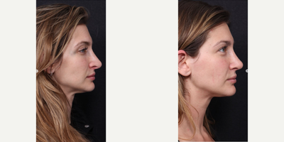 Revision Rhinoplasty before and after photo