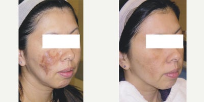 Skin Lightening before and after photo