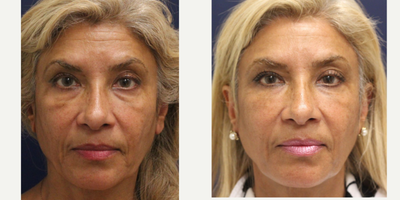 Bellafill before and after photo