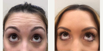 Botox before and after photo