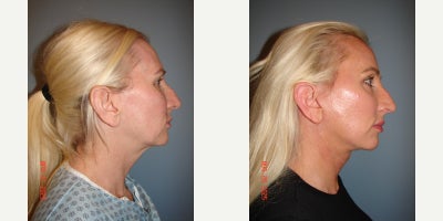 Deep Plane Facelift before and after photo