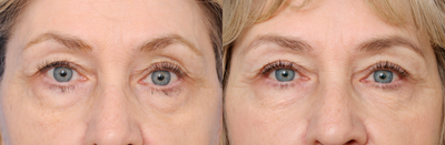 Eyelid Surgery before and after photo