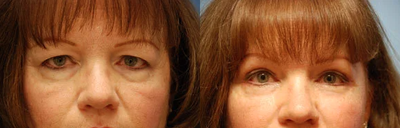 Eyelid Surgery before and after photo