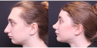 Genioplasty before and after photo