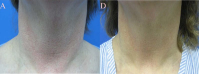 IPL before and after photo