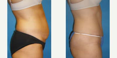 Tummy Tuck before and after photo