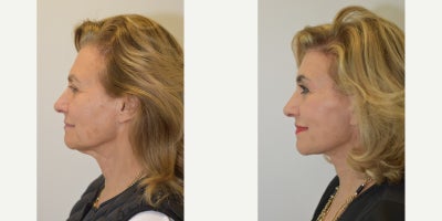 Brow Lift before and after photo