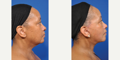 Facelift before and after photo