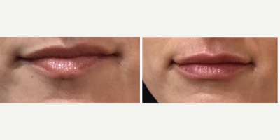 Juvederm before and after photo