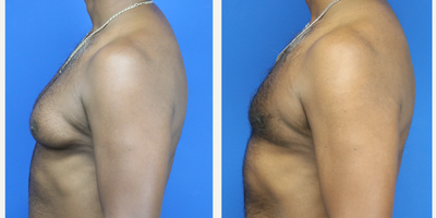 Gynecomastia Surgery before and after photo