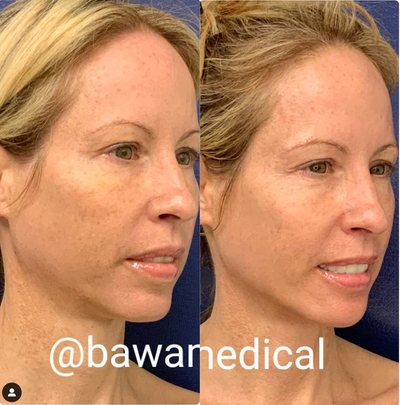 Laser Resurfacing before and after photo