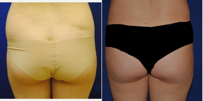 Liposuction before and after photo