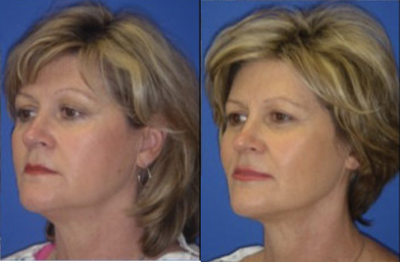 Liposuction before and after photo