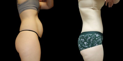 Liposuction before and after photo