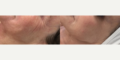 Microneedling before and after photo