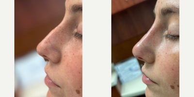 Rhinoplasty before and after photo
