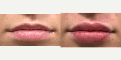 Juvederm before and after photo