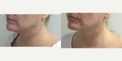Ultherapy before and after photo