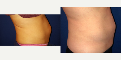 CoolSculpting before and after photo