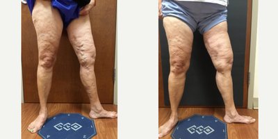 EVLT before and after photo