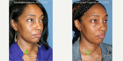 Eyelid Surgery before and after photo