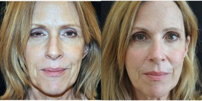 Sculptra before and after photo