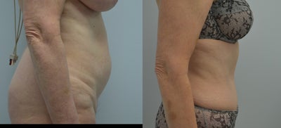 Tummy Tuck before and after photo