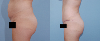 Tummy Tuck before and after photo