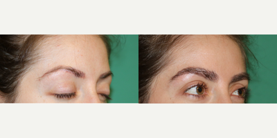 Eyebrow Transplant before and after photo