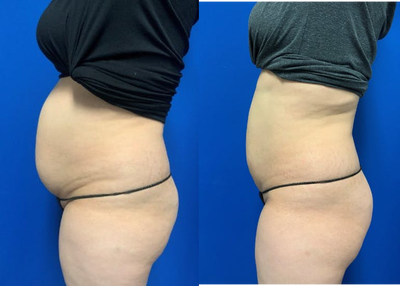 SculpSure before and after photo