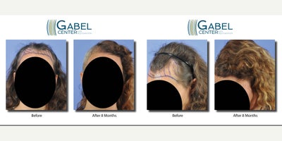 Hair Loss Treatment before and after photo
