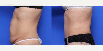 Tummy Tuck before and after photo