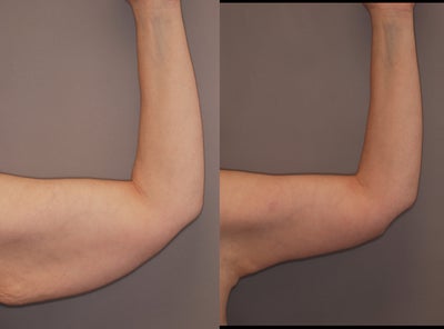 Arm Lift before and after photo