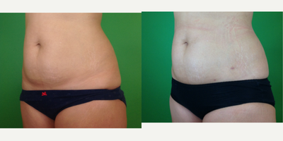 BodyTite before and after photo