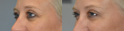 Botox before and after photo