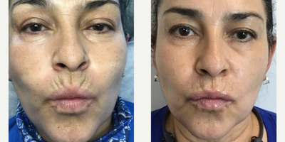 Dermal Fillers before and after photo