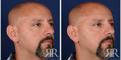 Rhinoplasty before and after photo