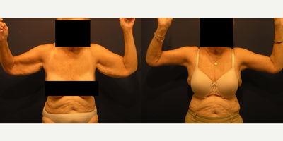 Arm Lift before and after photo