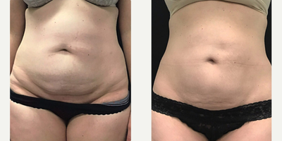 BodyTite before and after photo