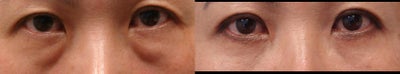 Eyelid Surgery before and after photo