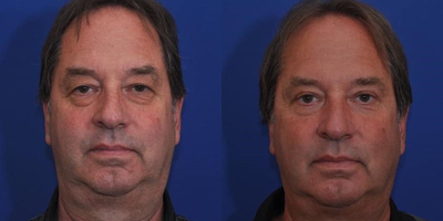 Eyelid Surgery before and after photo