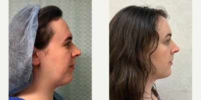 Facial Feminization Surgery before and after photo
