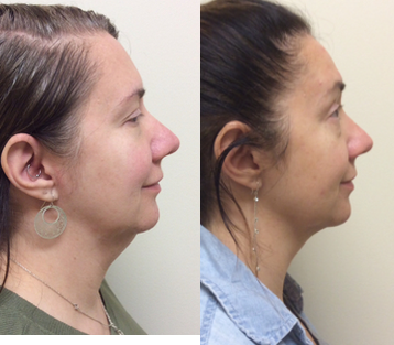 Kybella before and after photo