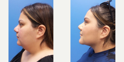 Liposuction before and after photo