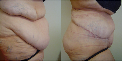Tummy Tuck before and after photo