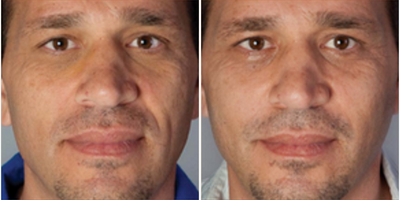 Bellafill before and after photo