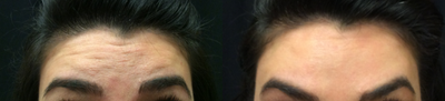 Botox before and after photo