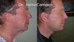 Facelift before and after photo
