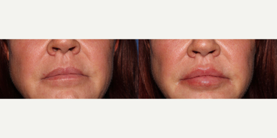 Lip Fillers before and after photo
